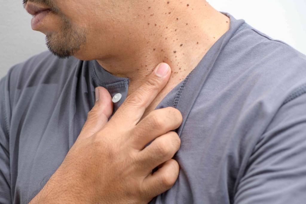 men's skin problems - skin tags