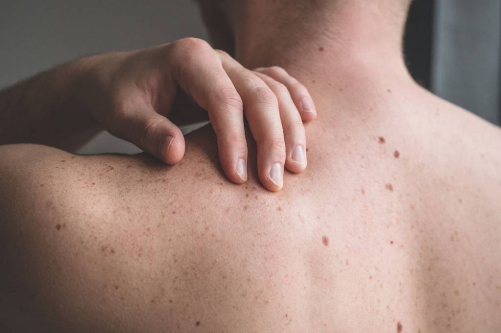 men's skin problems - mole removal