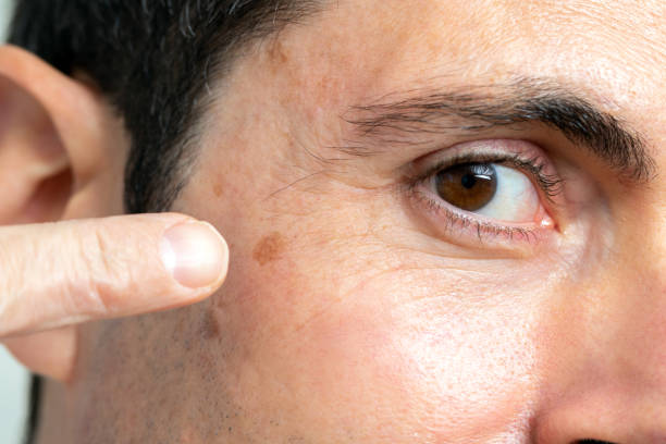 men's skin problems - warts
