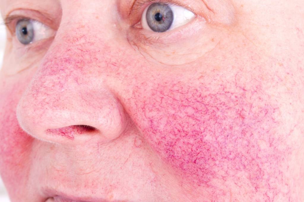 men's skin problems - rosacea