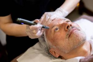 microneedling